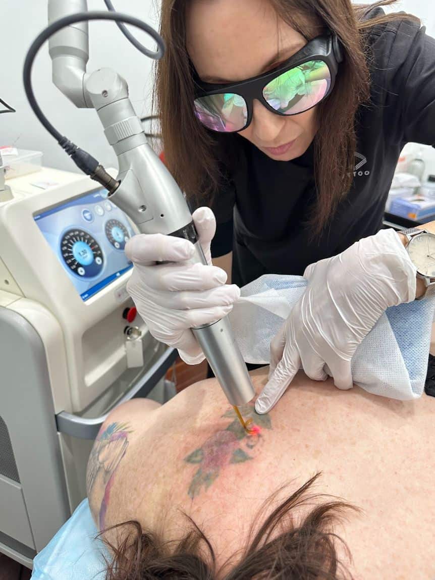 Laser Tattoo Removal